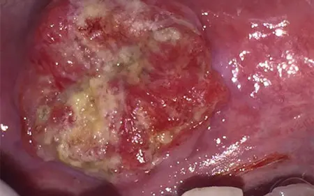 tongue cancer image