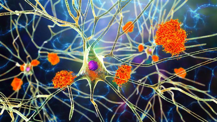 Amyloid plaques form among neurons in Alzheimer's disease. New research suggests cholesterol plays a key role.