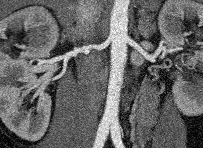 The “string of beads” appearance typical of fibromuscular dysplasia in the right renal artery (at left) visible on a coronal computed tomography angiogram scan.