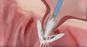 Mitral Valve Regurgitation: Studies Now Enrolling at UVA