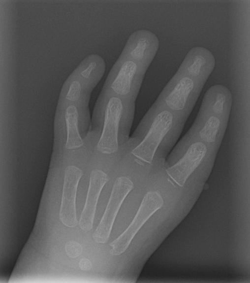 Connor Woodle's hand prior to surgery