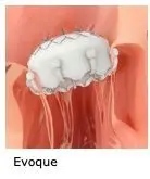 Novel and Less-Invasive Options for Tricuspid Valve Regurgitation Now Available Through Clinical Trials Enrolling at UVA