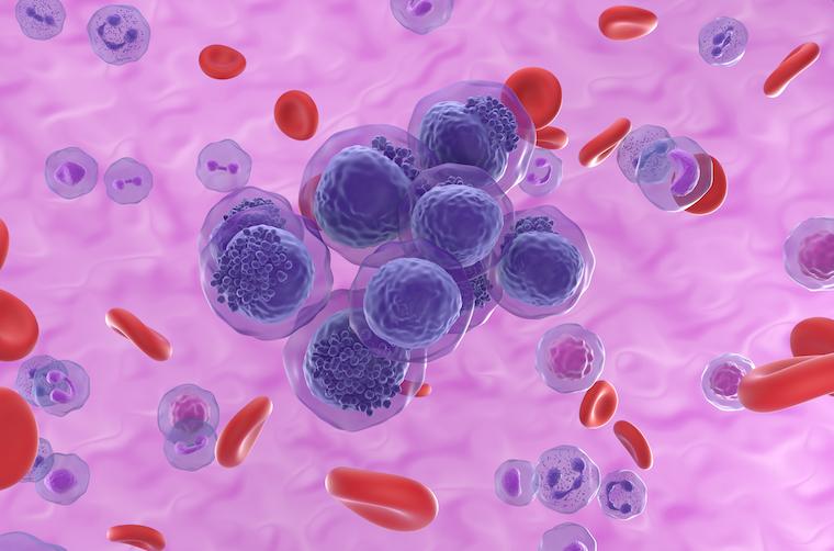 An illustration of acute myeloid leukemia.