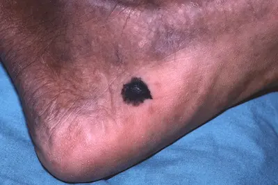 melanoma on the foot