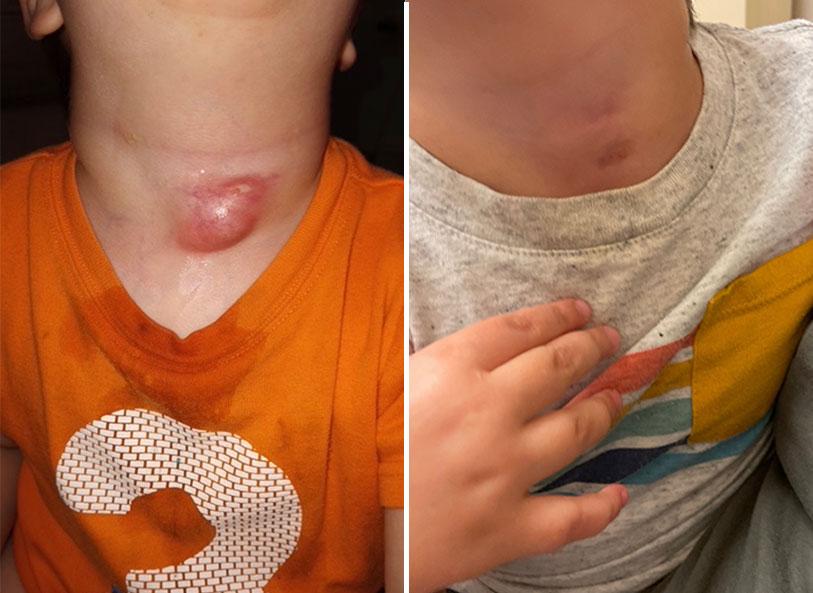 Two side by side pictures of children's throats following procedure, 1 with noticeable scar the other without