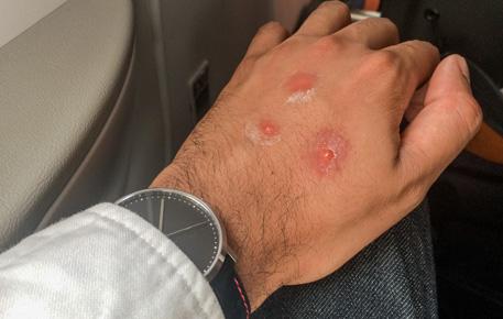 Surgery to Minimize Scars