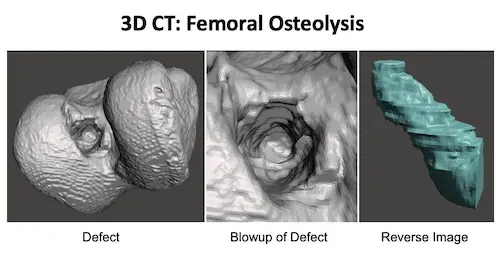When ACL Reconstruction Fails: UVA Health Surgeons Using Novel Techniques to Address Biologic Failure