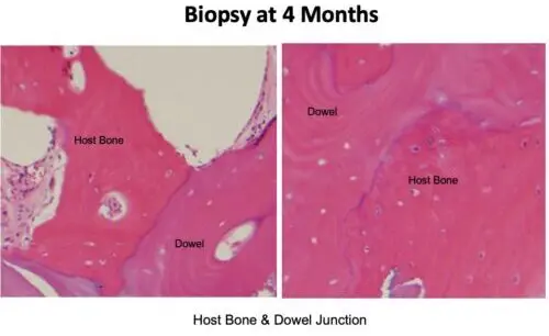 When ACL Reconstruction Fails: UVA Health Surgeons Using Novel Techniques to Address Biologic Failure