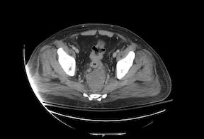CT scan showing rectosigmoid cancer with pelvic abscess