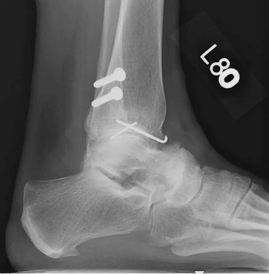 Case Study: Total Ankle Arthroplasty
