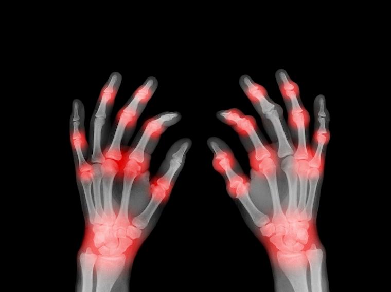 Rheumatoid arthritis is a chronic inflammatory condition that can damage joints.