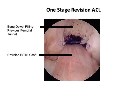 When ACL Reconstruction Fails: UVA Health Surgeons Using Novel Techniques to Address Biologic Failure