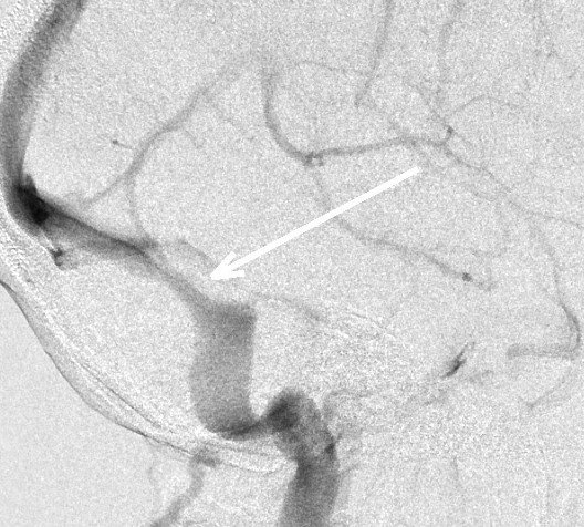 Intracranial venous stenosis prior to stent placement (above) and after (below)