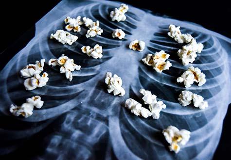 Popcorn lung disease has no cure. 