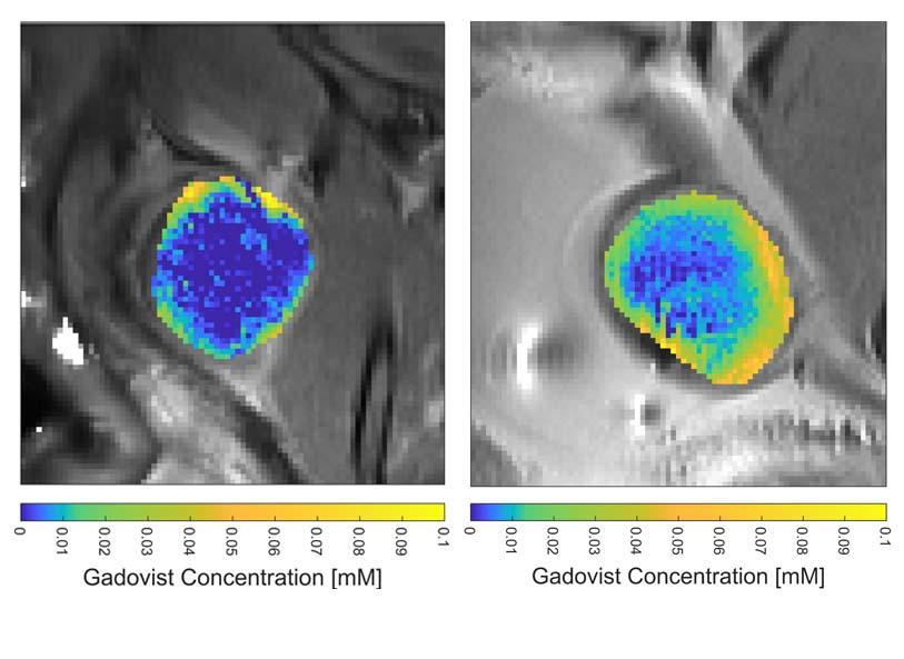 MRI images show brain tumor in a mouse before (left) and after focused ultrasound drug delivery treatment