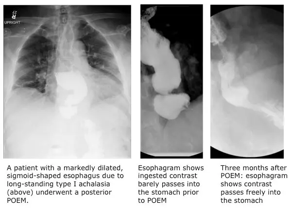 Minimally-Invasive Procedure to Treat Achalasia Is Part of Emerging Field of Advanced Gastrointestinal Endoscopy