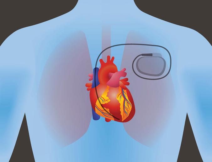 the heart of human and artificial cardiac pacemaker