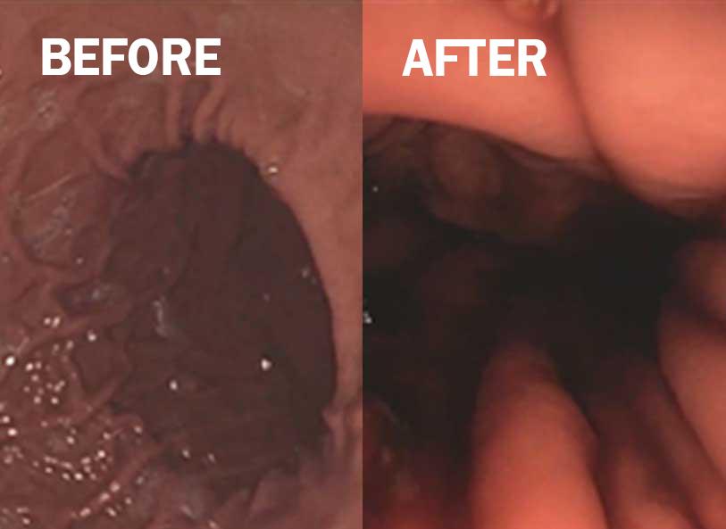 Via Apollo Endosurgery before and after