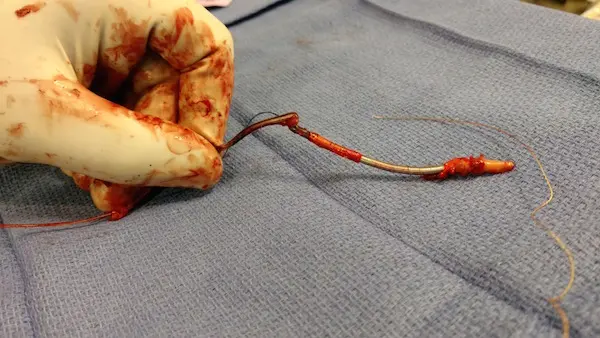 UVA Broadens Expertise to Safely Manage and Extract Cardiac Implantable Electronic Devices and Leads