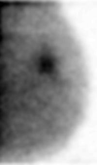 Imaging results from Armstrong's case (courtesy of Radiological Society of North America, Inc.). Figure A is the 3-D anatomical image and shows regions of radiodense breast tissue (the white areas). Figure B is the 3-D functional image and contains a dark