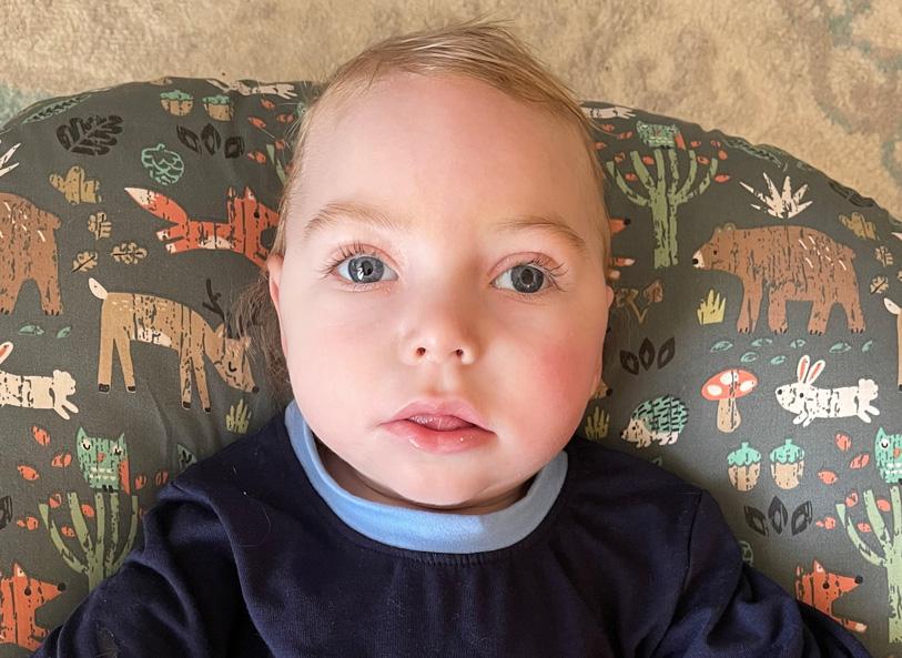 Close-up of a baby who was born with GNAO1