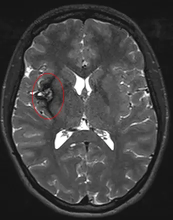 Cavernoma, image 4