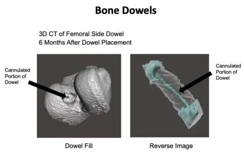 When ACL Reconstruction Fails: UVA Health Surgeons Using Novel Techniques to Address Biologic Failure