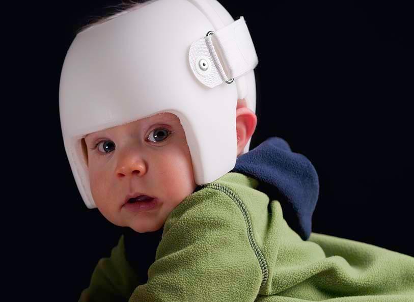 A seven month old baby wearing a helmet or "band' for the treatment of plagiocephaly, or misshapen head.