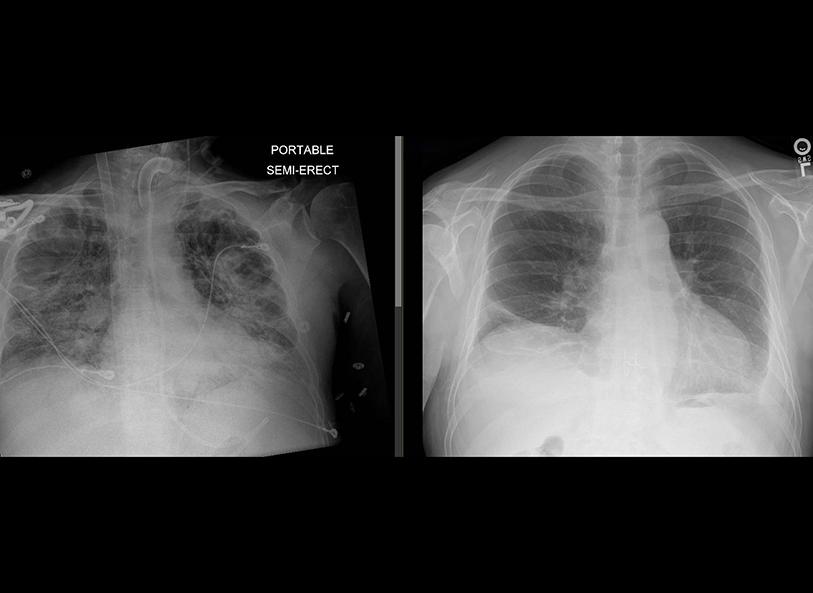 Chest X-ray of a UVA Health patient pre and post COVID-related lung transplant