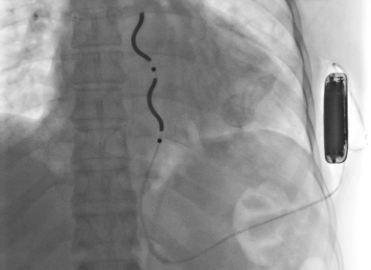An implantable cardioverter defibrillator seen on this imaging scan