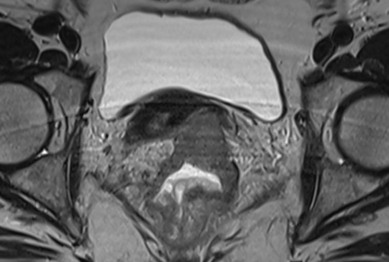 Magnetic resonance imaging (MRI) can spare patients with rectal cancer from surgery by identifying those who can "watch and wait," new research from the School of Medicine suggests.