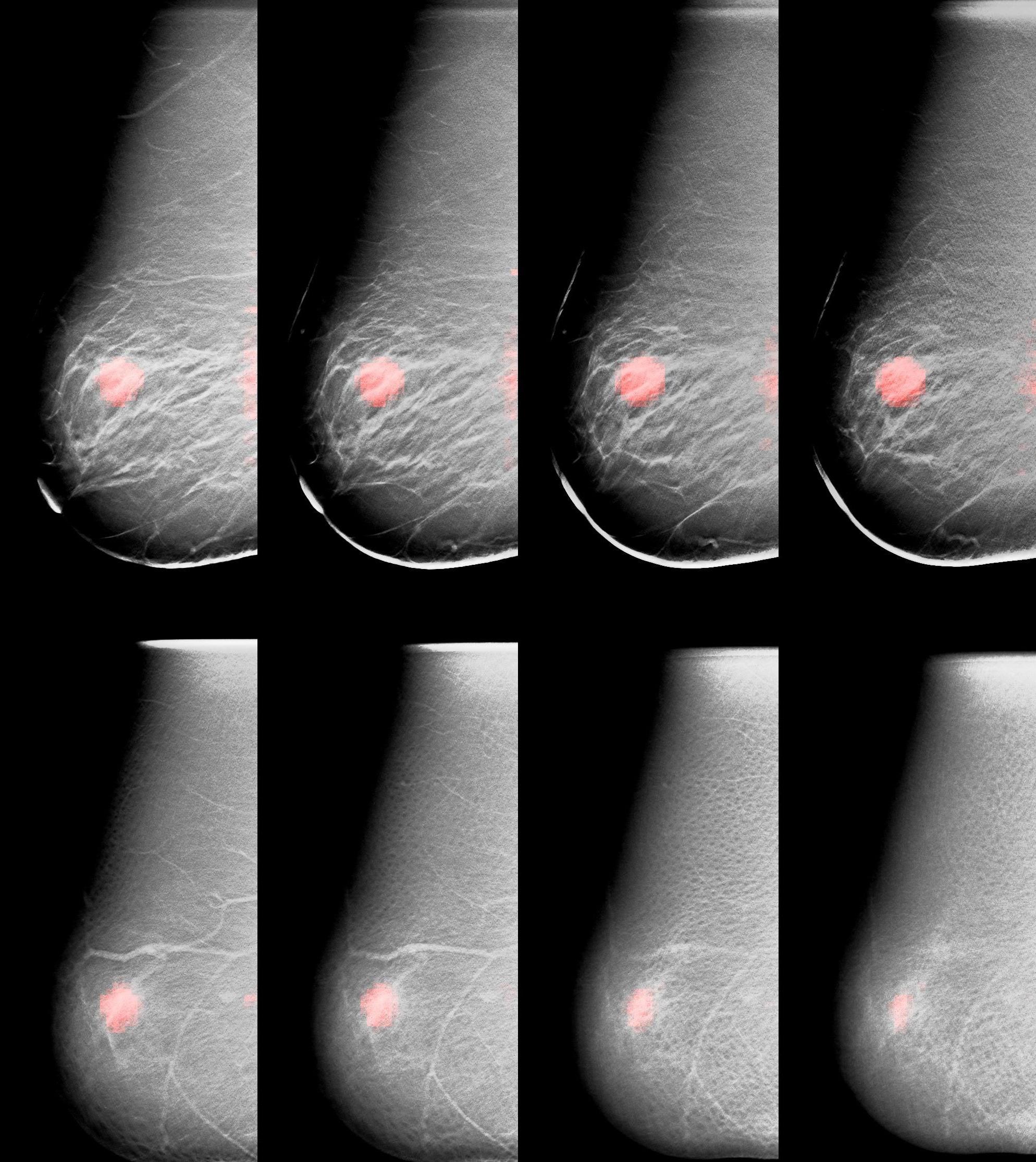 A montage showing the fusion of slices taken with X-ray and molecular breast tomosynthesis