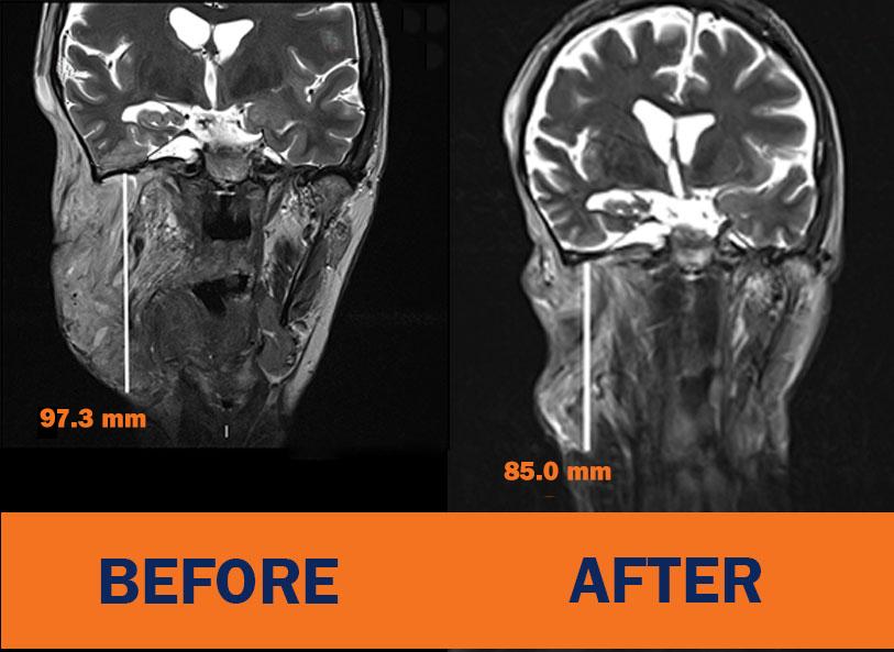 Coronal T2 weighted MRI of a facial plexiform neurofibroma immediately prior to and after 40 months of treatment with the study drug mirdametinib. Per independent radiology review, the tumor decreased 34.7% in area.