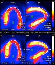 A series of cardiac PET scan images highlight the global reduction in blood flow at stress characteristic of impaired arteriolar dilation in microvascular disease.