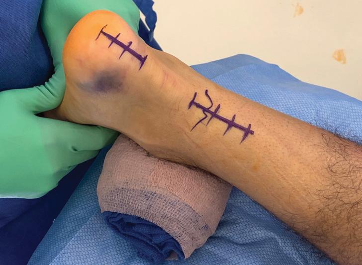 Incisions for primary Achilles repair with docking technique
