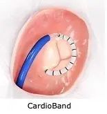 Novel and Less-Invasive Options for Tricuspid Valve Regurgitation Now Available Through Clinical Trials Enrolling at UVA