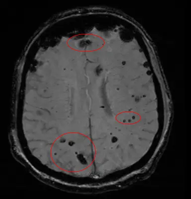 Cavernoma, image 1