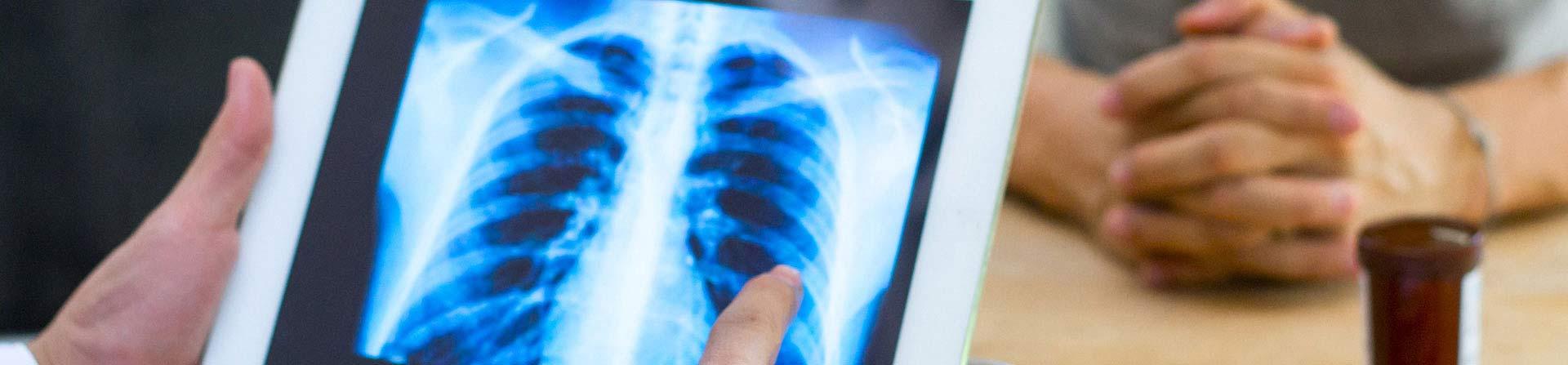 Lung cancer scan