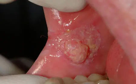 oral cancer inside a cheek
