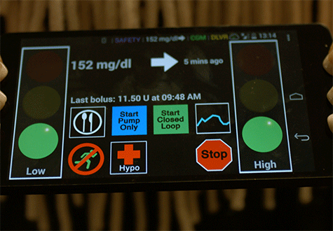 artificial pancreas app