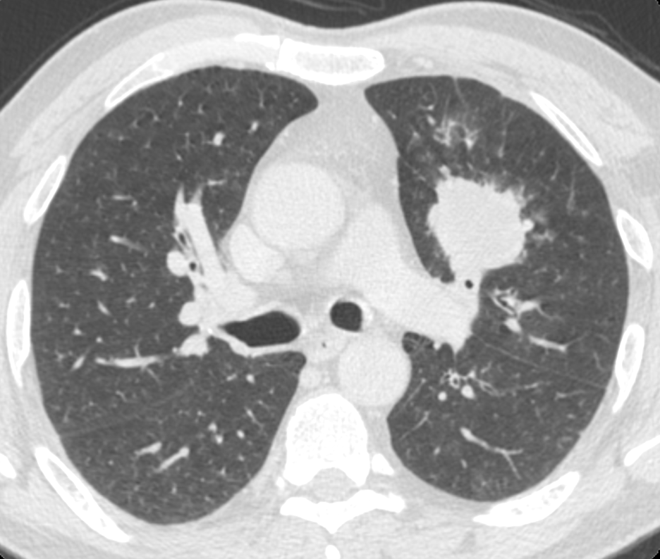 UVA Health Cancer Center is joining other top cancer organizations in seeking to boost access to lung cancer screenings for high-risk patients.