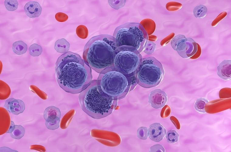 An illustration of the blood cancer known as acute myeloid leukemia