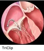 Novel and Less-Invasive Options for Tricuspid Valve Regurgitation Now Available Through Clinical Trials Enrolling at UVA