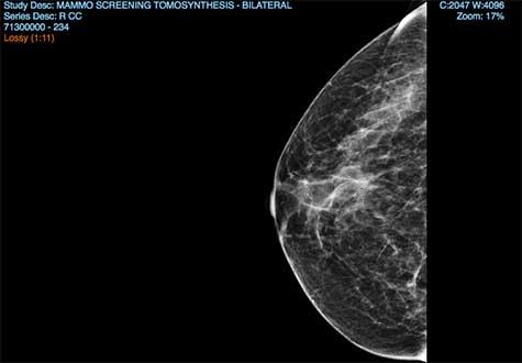 mammogram image