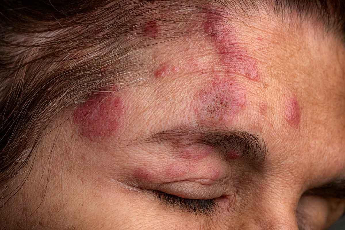 Shingles plaques show up red and painful on a person's face