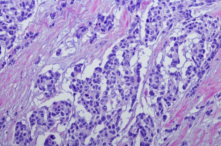 Rhabdomyosarcoma is an aggressive form of cancer that typically strikes children under 18.