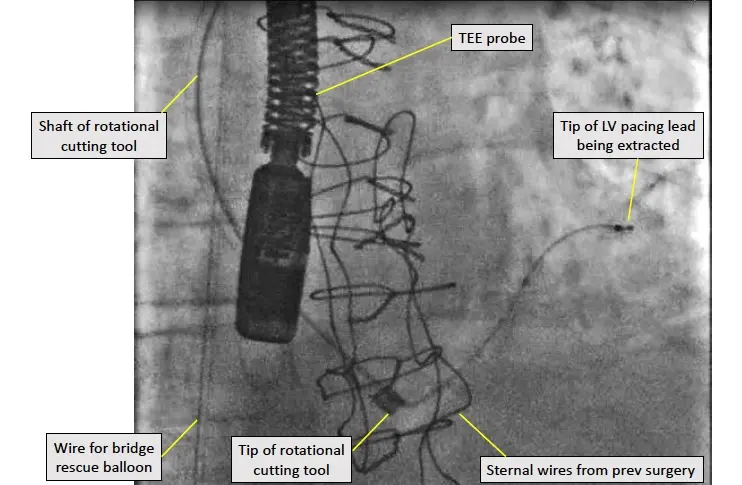 UVA Broadens Expertise to Safely Manage and Extract Cardiac Implantable Electronic Devices and Leads