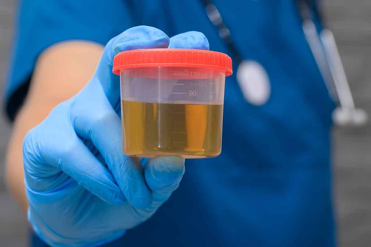 A dr holds a sample of urine to test for a UTI.