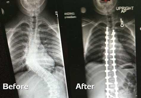 Gresham Wagner Scoliosis