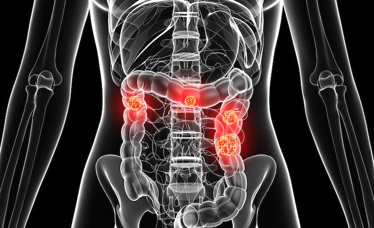 Women who live in rural areas are less likely to be screened for colorectal cancer than their urban counterparts, a new study finds.